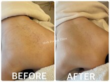 ハーブピーリング 恵比寿/毛孔性苔癬/背中ニキビ