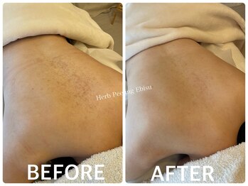 ハーブピーリング 恵比寿/毛孔性苔癬/背中ニキビ