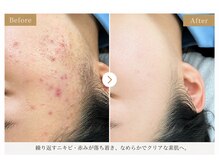サロン ド ラジュニール(Salon de Rajeunir)/繰り返すニキビにお悩みでご来店