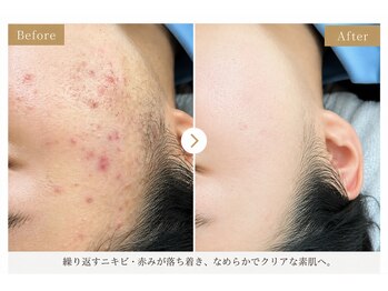サロン ド ラジュニール(Salon de Rajeunir)/繰り返すニキビにお悩みでご来店