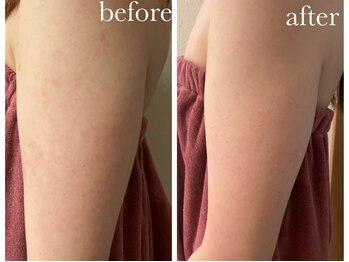 シャルナ(charna)/ハーブピーリング症例