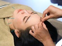 頭とお顔の鍼×微弱電流でしわ・たるみ・くすみを改善☆