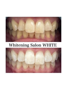 ホワイトニングサロン ホワイト 前橋店(WHITE)/圧倒的白さのホワイトニング