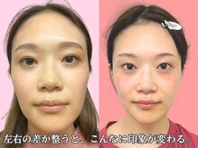 ナチュラルビューティーフェイス 横浜(NBF)/ビフォーアフター写真