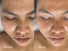 イースト(EAST)/プラズマシャワー4回