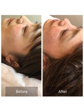 爽健美/美容鍼効果