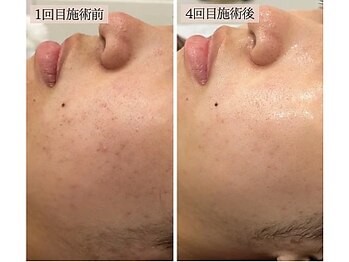 リノン(LINON)/陶肌ピール 施術回数4回