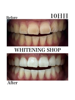 ホワイトニングショップ 豊橋店(WHITENING SHOP)/Before&After　10日目のお客様