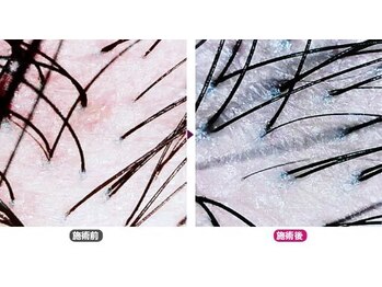 ワヤンプリ 麻布十番店/頭皮スコープ診断[港区/麻布]