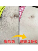 フェリッセ(FELISSE)/Before ＆ After （お腹）　3回