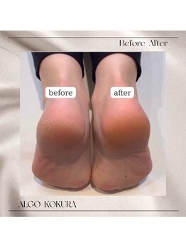 アルゴ 小倉守恒店(ALGO)/脱毛前にスクラブをプラス!!