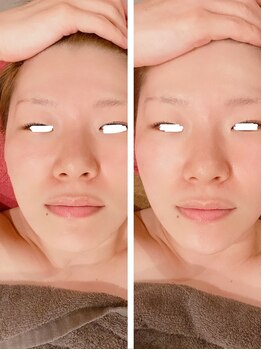 カモン(KAMON)/美顔矯正1回目