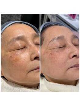 ピュア 川越店/光フェイシャル