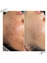 イチロクイチハチ(1618)/肌が弱くてもケアできます