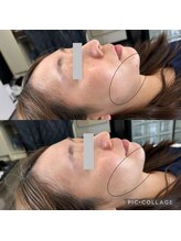 ワイ(Y)/たった一度でリフトアップも！！