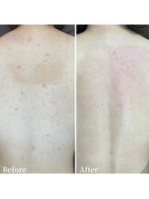 ニキビケア 毛穴研究所 立川店/赤みや背中ニキビでお悩みの方へ