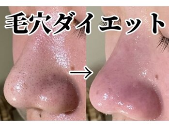 チル(Chill)/【感動の毛穴ダイエット】