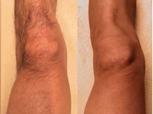 脱毛を始めるには冬が最適！まずは一部位からでもご相談ください