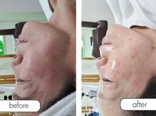 エステルーム ココ(COCO)/ミコステラ施術後