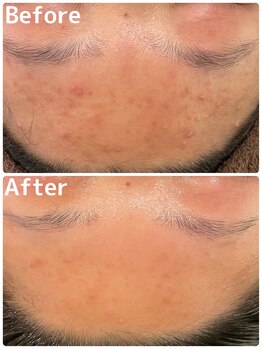 シュシュ 立川駅前(ChouChou)/トラブル肌を改善!