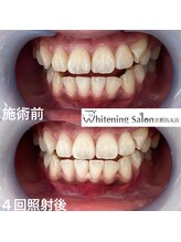 ホワイトニングサロン 京都烏丸店/ホワイトニング施術例