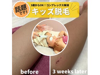 サロン(SALON)/キッズ脱毛：腕