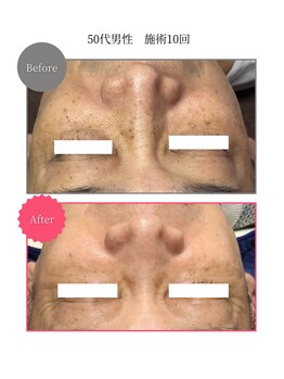 ボータン 恵(Beau Temps)/ウルトラ光トーニング/シミ改善