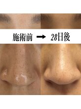 コリー(Kolly)/シミケア１回目