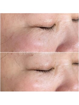 ラウレア(Laule'a)/美脳ドライヘッドスパ