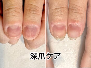 レヴィア(Revia)の写真/パラジェル×深爪×巻き爪ケアできるサロン【見せたくなる指先に◆深爪ケア（ケア用品付）13,500円】