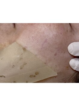 シミしわ改善！予防ケア