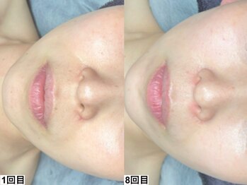 アンドミー 小倉(&me)/肌負担の少ない最新ピーリング