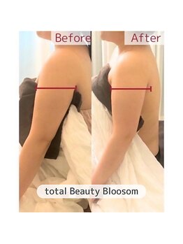 Blossom 【ホワイトニング/脱毛/韓国肌管理/毛穴洗浄】【3/23 NEW OPEN(予定)】/REDSHOT　二の腕