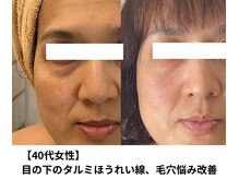 ボニータ(Bonita)/【Lit】ヒト臍帯幹細胞エステ