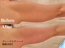 銀座ナチュラルスタイル/ヴィーナスDIVA二の腕脂肪ケア