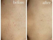 シャルナ(charna)/ハーブピーリング症例