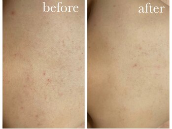 シャルナ(charna)/ハーブピーリング症例