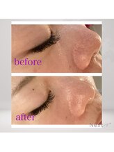 ルシアス(LUCIAS)/ハーブピーリングで美毛穴に