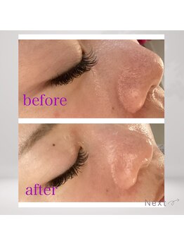 ルシアス(LUCIAS)/ハーブピーリングで美毛穴に