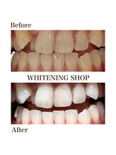 ホワイトニングショップ 函館店(Whitening Shop)/Before &Afterホワイトニング