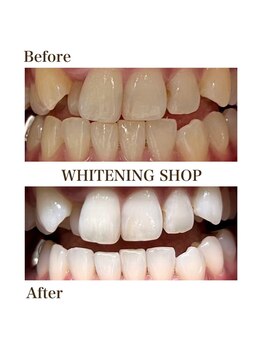 ホワイトニングショップ 函館店(Whitening Shop)/Before &Afterホワイトニング