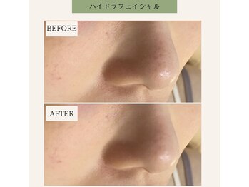 ライム(LIME)/ハイドラフェイシャル