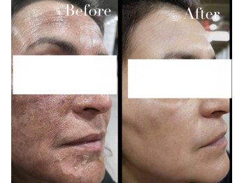 アブニールブリヨン/2BBioハーブピーリング/肌質改善