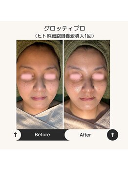 ボディケアサロン アイリフ(airef)/ビフォーアフター