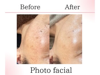 サロンツキ(salon tuki)/光フェイシャル症例/徳島