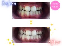 エクシアホワイトニング 草津店/ホワイトニングビフォーアフター