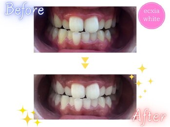 エクシアホワイトニング 草津店/ホワイトニングビフォーアフター