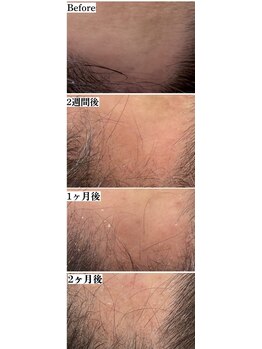 スターティス(STATICE)/ノアグロウ スカルプ