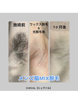 シュバル(CHEVAL)/ワックス脱毛1ヵ月後♪
