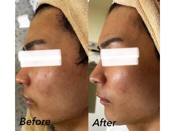 マーレン(Malen)/【クリスティーナ症例写真】